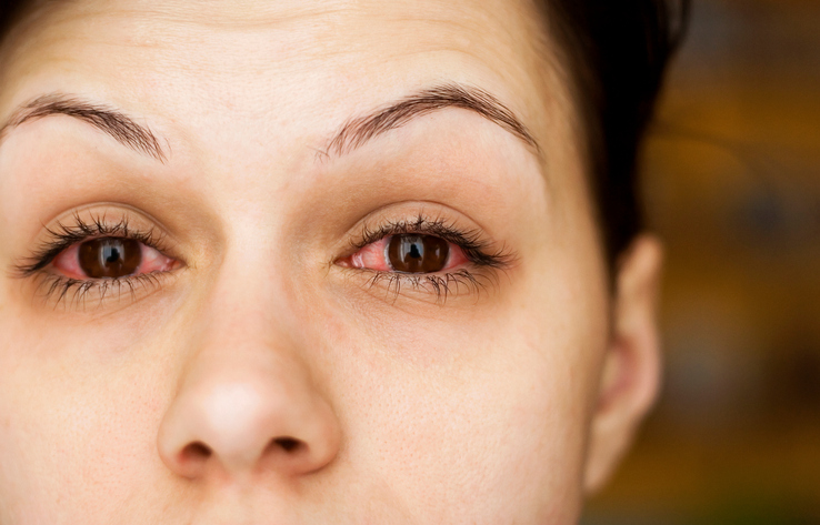 Pink Eye (Conjunctivitis) Treatment and Diagnosis