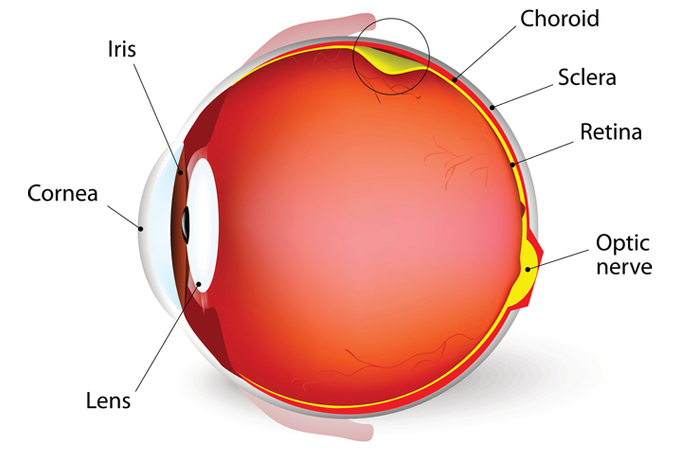 Retinal Detachment