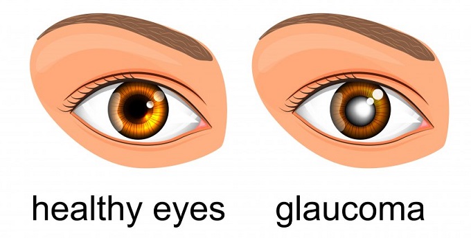 Glaucoma